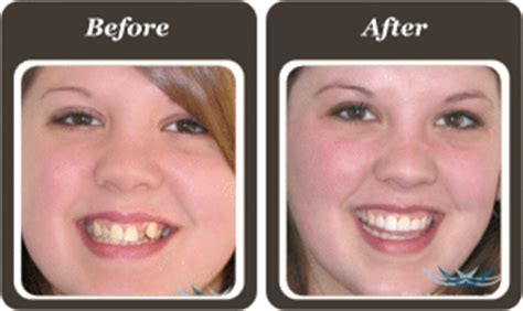 The treatment time can vary. 6 Month Smiles