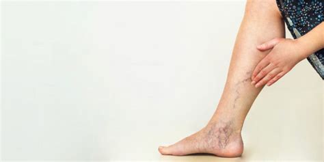 Varicose Veins Patient Story Pristyn Care