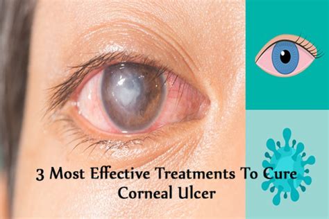 Diagnosis And Treatment Of Corneal Ulcers Obn