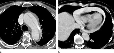 Acute Cardiac Tamponade Due To Ruptured Aortic Dissection A Axial