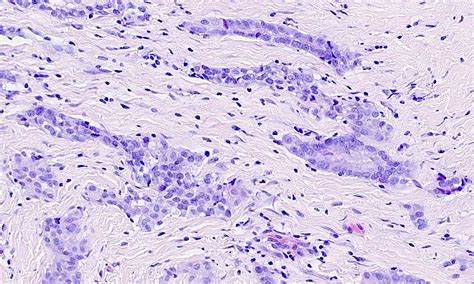 Epithelioid malignant mesothelioma pathology outlines. Pathology Outlines - Mesothelioma - epithelioid