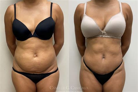 Is Liposuction Safer Than A Tummy Tuck Cosmetic Surgery Tips