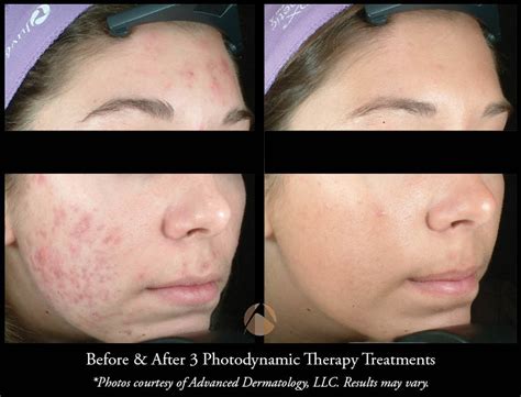 Photodynamic Therapy For Acne Pdt Chicago Il Advanced Dermatology
