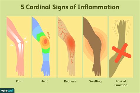 The inflammatory response is chemically mediated. What Are the 5 Cardinal Signs of Inflammation?