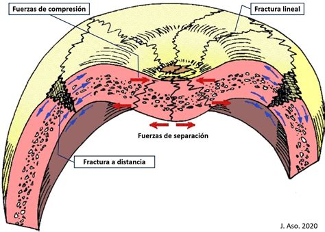 Aspectos Medicolegales De Las Fracturas Craneales