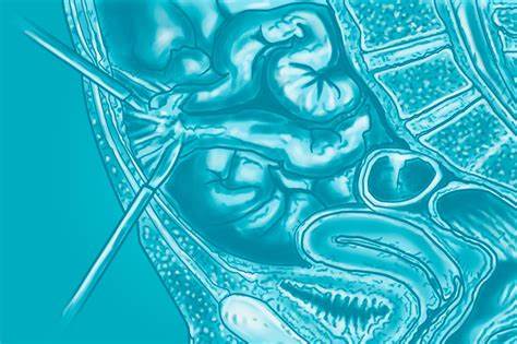 Удаление аппендицита — цена на удаление аппендикса в Киеве, стоимость Картинка - Удаление аппендицита — цена на удаление аппендикса в Киеве, стоимость