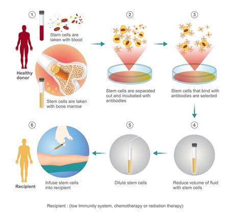 Allogeneic Bone Marrow Transplantation - UniHealth Turkey