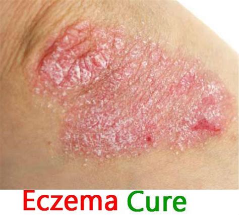 But identifying your type of eczema can take a little research. Best Soap For Eczema | Get rid of eczema, Eczema symptoms ...