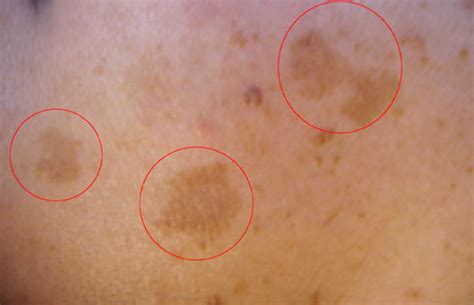 What Causes Uneven Skin Tone And How To Treat It Lazer Lounge Med Spa