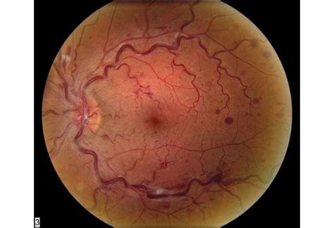 Central Retinal Vein Occlusion Crvo Wills Eye Hospital