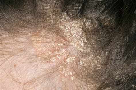 Psoriasis On The Scalp Stock Image C0029656 Science Photo Library
