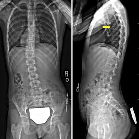 Thoracic Mri At First Visit Shows Compression Fractures Of T T And