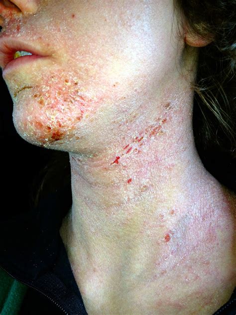 Scratching The Surface Of Topical Steroid Withdrawal October 2014