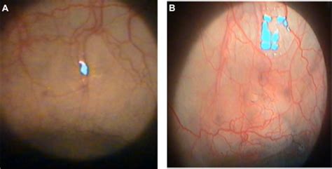 A Corkscrew Vessels On Bleb In Periphery And B Vascularization On