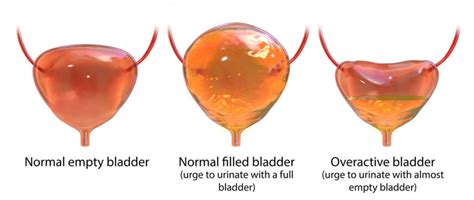 Overactive Bladder Center For Urologic Care Of Berks County