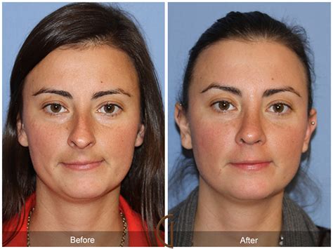 Septoplasty Surgery And Candidacy Gallery Of Cosmetic Surgery