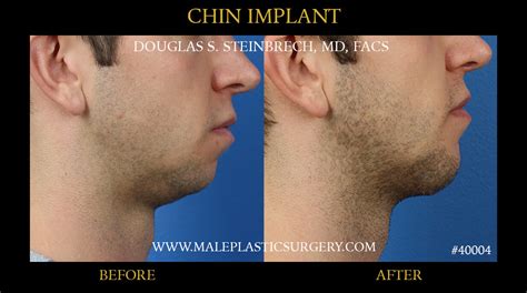 Chin Implants Gallery Male Plastic Surgerymale Plastic Surgery