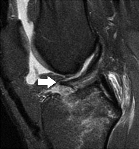 Schatzker Classification Of Tibial Plateau Fractures Use Of Ct And Mr