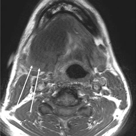 Axial T1 Weighted Facial Bone Mri Without Fat Suppression The Lesion