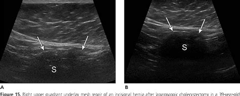 Figure 15 From Abdominal Wall Hernia Mesh Repair Sonography Of Mesh
