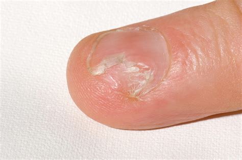Fungal Nail Infection Photograph By Dr P Marazziscience Photo Library