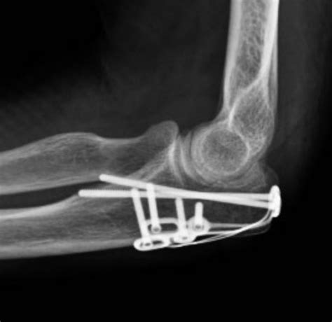 Olecranon Fracture Fixation Arm Docs