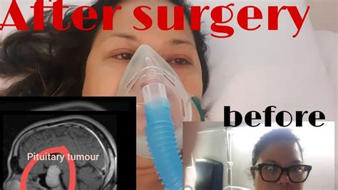 Pituitary Tumour 35cm Surgery Youtube