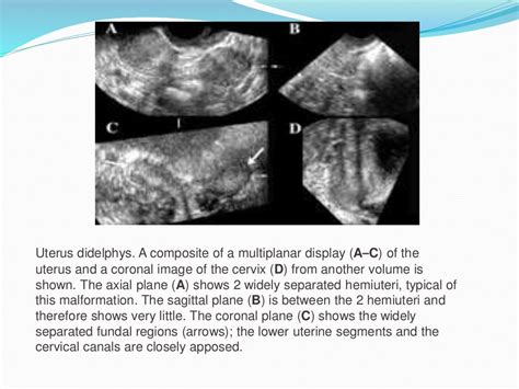 3 D Ultrasound In Gynecology Presentation