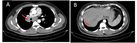 Ct Scan In Patient With Sarcoidosis A Pulmonary Lymphadenopathy And
