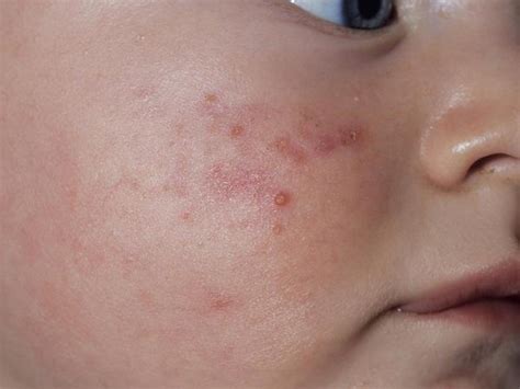 识别宝宝湿疹，口水疹，尿布疹儿童皮疹和皮肤状况（附照片慎入） 每日头条