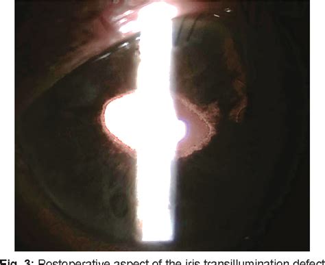 Figure 3 From A Rare Manifestation Of Uveitis Glaucoma Hyphema Syndrome