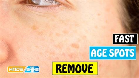 Remove Age Spots Fast Home Remedies To Remove Age Spots Youtube