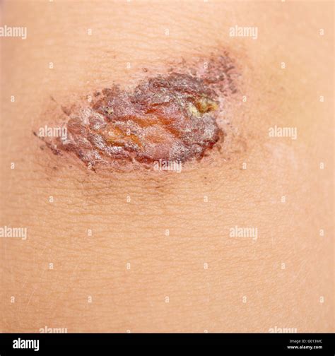 Scrape Skin Hi Res Stock Photography And Images Alamy