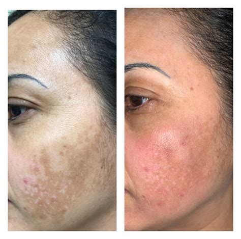 Hyperpigmentation Face Before And After