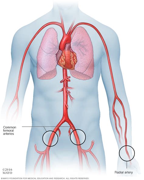 Spontaneous Coronary Artery Dissection Scad Disease