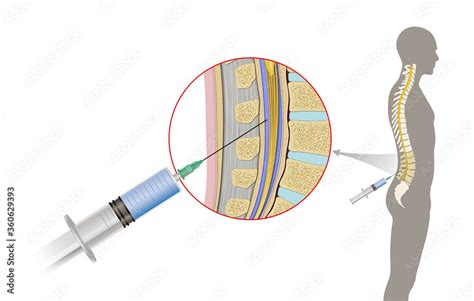 Fototapeta Lumbar Puncture Also Known As A Spinal Tap Is A Medical