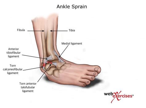 A sprained ankle can be very uncomfortable and outright painful. Understanding and Preventing Ankle Sprains Through ...