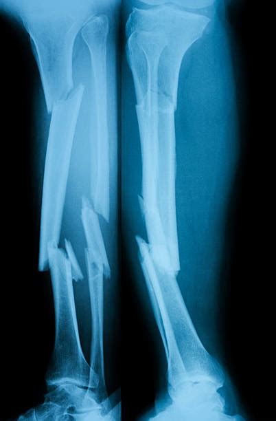 Best Broken Leg Xray Stock Photos Pictures And Royalty Free Images Istock