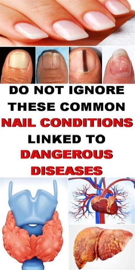 7 common nail conditions linked to serious diseases that you shouldnt ignore nail conditions