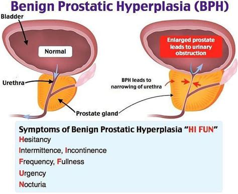 𝐁𝐞𝐧𝐢𝐠𝐧 𝐩𝐫𝐨𝐬𝐭𝐚𝐭𝐢𝐜 𝐡𝐲𝐩𝐞𝐫𝐩𝐥𝐚𝐬𝐢𝐚 𝐁𝐏𝐇 Benign prostatic hyperplasia Nurse training Nursing
