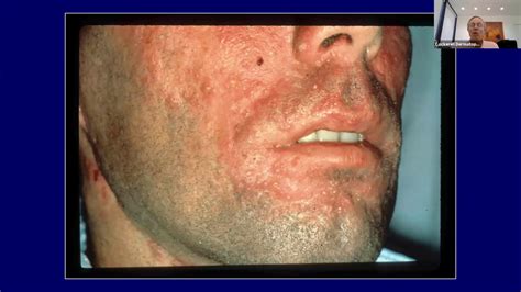 Cutaneous Blistering Disorders Youtube
