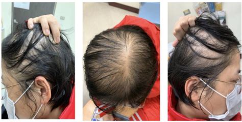 Genes Free Full Text Female Pattern Hair Loss An Overview With