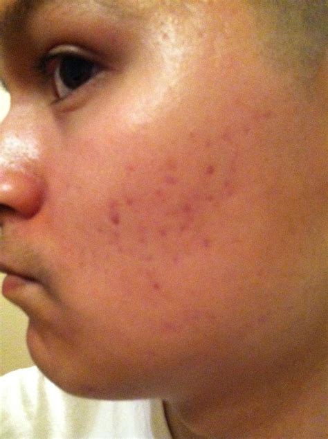 Red Marksscars On My Cheeks Left After Acne Pics Included