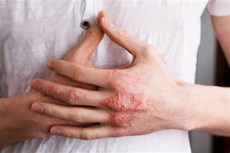 Rough Skin Dry Skin Dry Hands Universal Dermatology