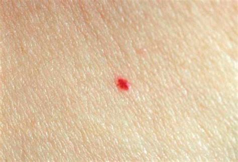 Bumpy skin that looks like tiny pinpricks or goosebumps could be keratosis pilaris. I have a few permanent red dots or spots on my skin and ...