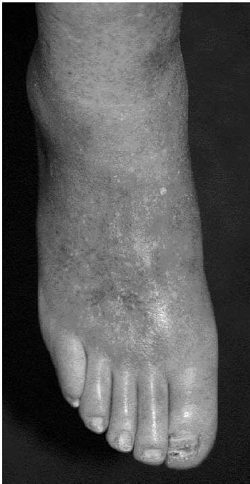 Photograph Of Right Foot Before Intertarsal Abscess Debridement