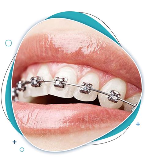 Dental Braces Glen Waverley Ek Dental Surgery