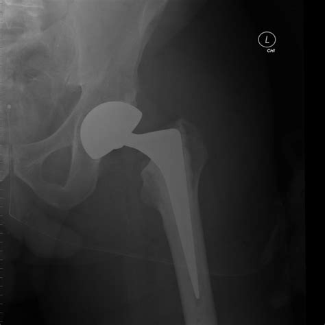 Pdf Fractures In The Elderly When Is Hip Replacement A Necessity