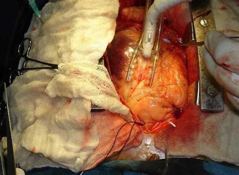 Heart Bypass Surgery Seen It In Real Life Bypass