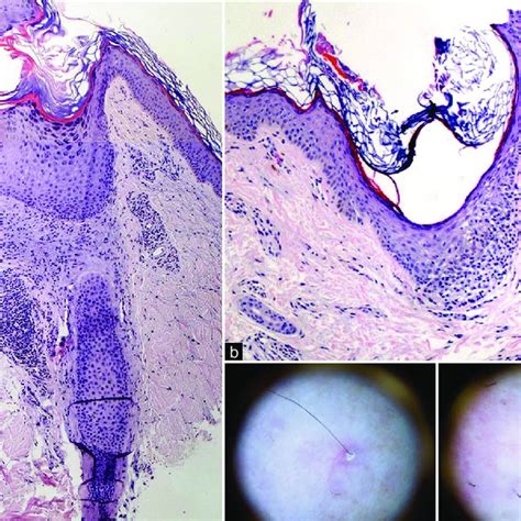 A Histopathology Of Lower Limb Shows Mild Follicular Hyperkeratosis